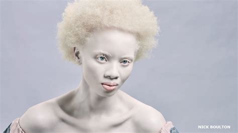 are all albinos black